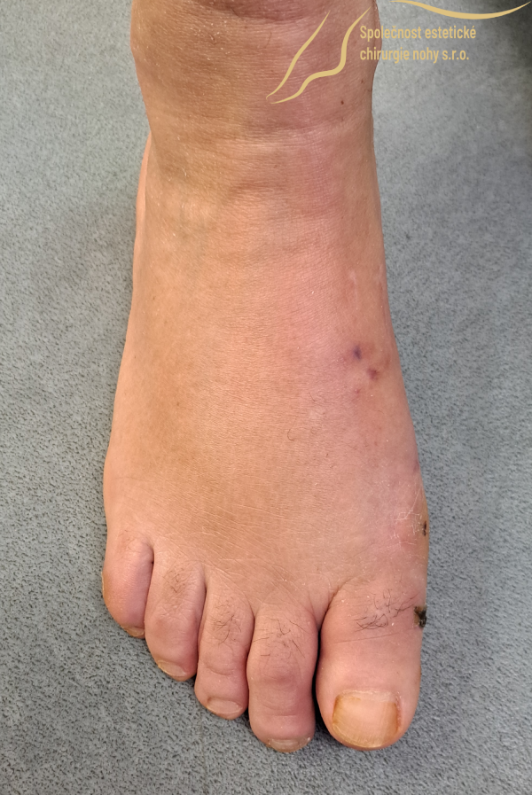 pooperačná fotka vbočeného palca pravej nohy 4 týždne po operácii